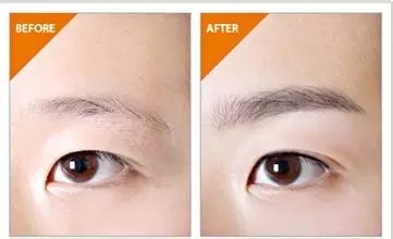 有哪些禁忌人群不適合眉毛種植