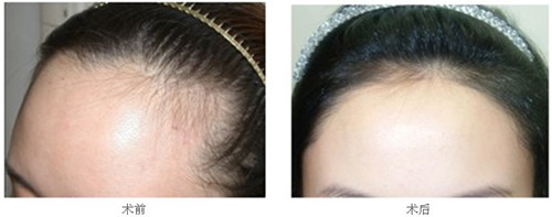 發(fā)際線移植術(shù)有哪些優(yōu)勢(shì)