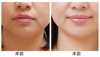 厚唇變薄手術(shù)費用多少