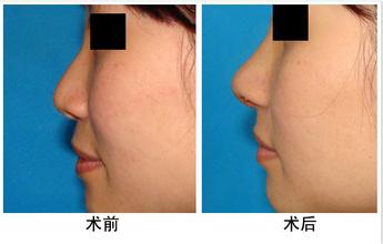 哪些鼻子適合做隆鼻術(shù)