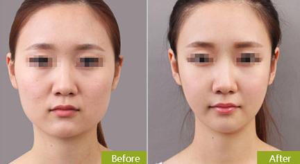 南京連天美整形醫(yī)院面部吸脂多少錢呢