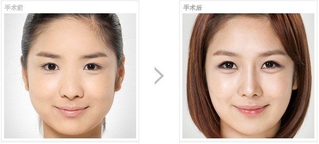 臥蠶整形有什么優(yōu)勢(shì)