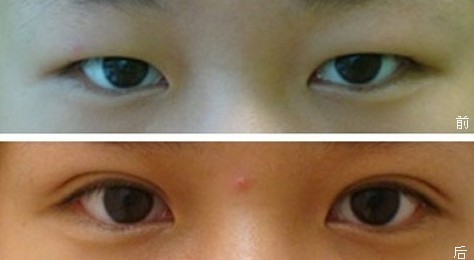 上眼皮下垂提升術(shù)幾種方法 - 珍美網(wǎng)