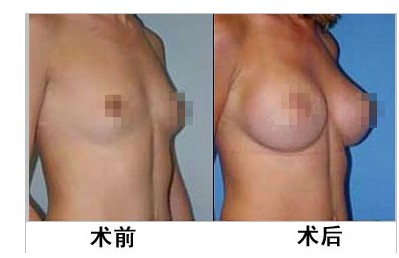 假體隆胸手術(shù)效果如何 - 珍美網(wǎng)