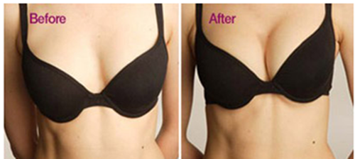 自體脂肪移植隆胸手術效果如何