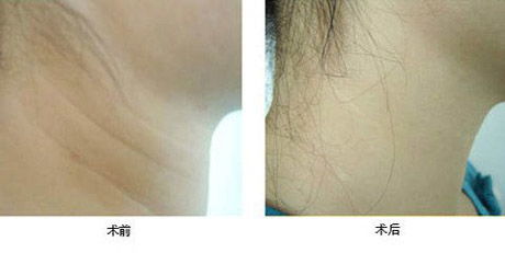 激光除皺術(shù)后如何護理