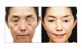 電波拉皮手術(shù)后如何預(yù)防