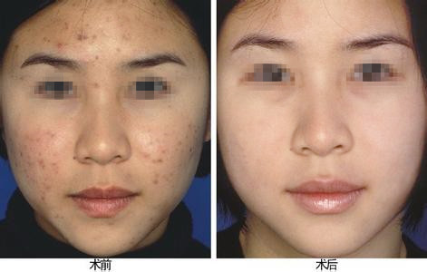 祛痘四大誤區(qū)