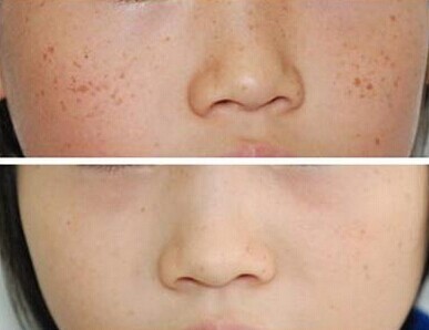 激光手術治療色素痣有什么禁忌癥?