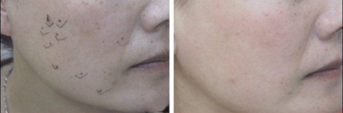 不同波長的激光去痣效果如何