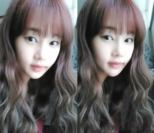 【3D回轉(zhuǎn)顴骨+地包天下巴矯正整形】 打造完美的自己 - 珍美網(wǎng)