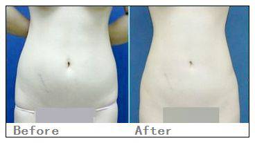 廣西南寧聯(lián)韓整形醫(yī)院腹部吸脂價(jià)格是多少