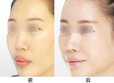 玻尿酸豐額頭的費(fèi)用是多少