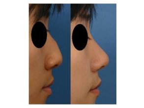 歪鼻矯正術(shù)后如何護(hù)理