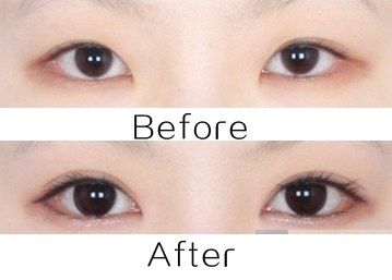 武崇高開眼角手術(shù)多少錢 - 珍美網(wǎng)