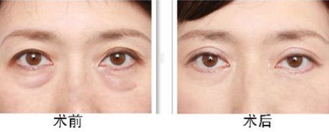 王海南去眼袋手術(shù)費用是多少 - 珍美網(wǎng)