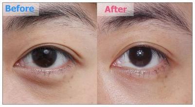 孫鵬激光去黑眼圈多少錢 - 珍美網