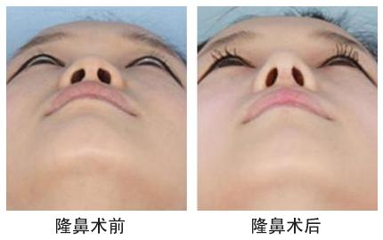 大連新華整形醫(yī)院膨體隆鼻手術(shù)價格是多少 - 珍美網(wǎng)