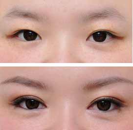 無(wú)錫春天整形醫(yī)院開眼角手術(shù)費(fèi)用是多少 - 珍美網(wǎng)