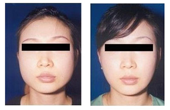 劉娟面部整形價(jià)格是多少 - 珍美網(wǎng)