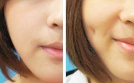 陳剛酒窩成形術(shù)多少錢