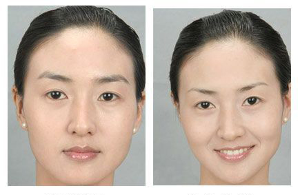 提眉的哪五種手術(shù)方法 - 珍美網(wǎng)