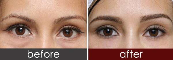 激光去眼袋有何效果 - 珍美網(wǎng)