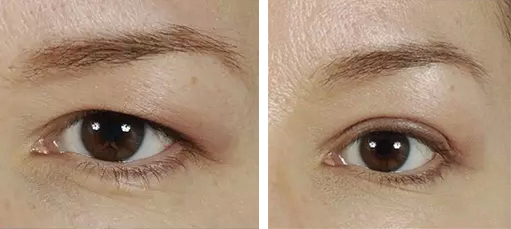 提眉手術(shù)價(jià)格多少錢(qián) - 珍美網(wǎng)