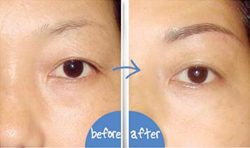 韓式提眉手術(shù)的價(jià)格是多少 - 珍美網(wǎng)