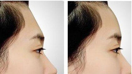 自體脂肪豐額頭的價(jià)格是多少