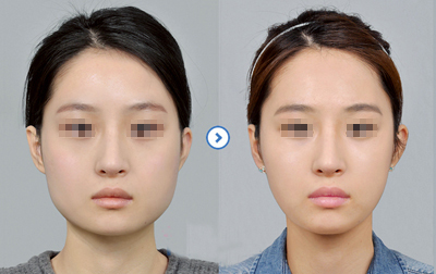 下頜角整形術(shù)有哪些并發(fā)癥 - 珍美網(wǎng)