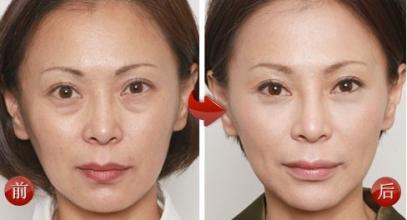 電波拉皮除皺費(fèi)用多少錢