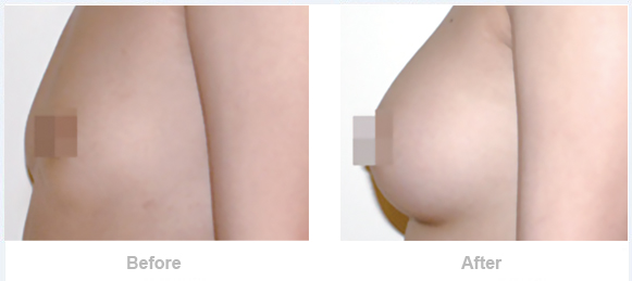 自體脂肪隆胸的危害有哪些