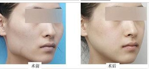 下頜角手術(shù)效果怎么樣 - 珍美網(wǎng)