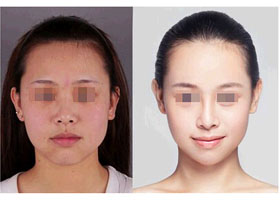 彩光嫩膚價格是多少錢