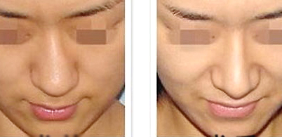 歪鼻矯正效果怎么樣