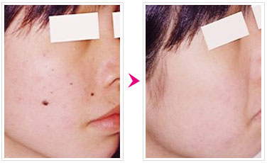 激光去痣的費(fèi)用是多少