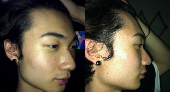 隆鼻手術(shù) 屌絲逆襲成高富帥 - 珍美網(wǎng)