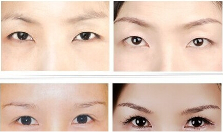 韓式開(kāi)眼角有哪些特點(diǎn)