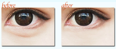 激光去眼袋手術(shù)價(jià)格是多少 - 珍美網(wǎng)