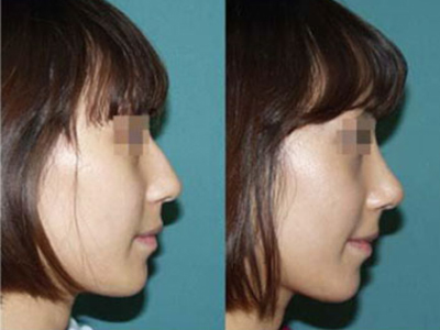 鼻翼縮小手術(shù)價格多少錢 - 珍美網(wǎng)