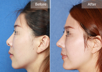 隆鼻失敗修復(fù)有什么方法