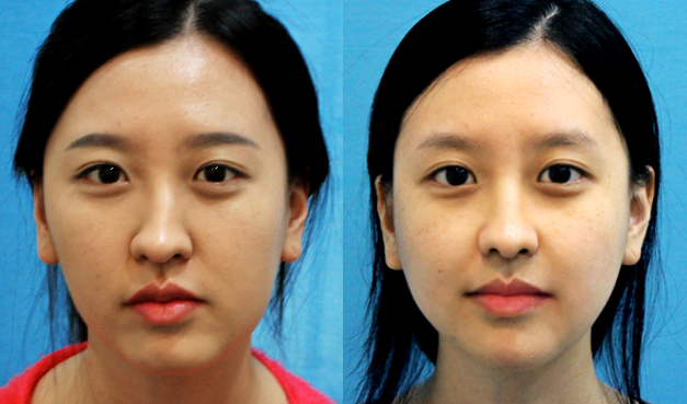 鼻骨整形術(shù)多少錢