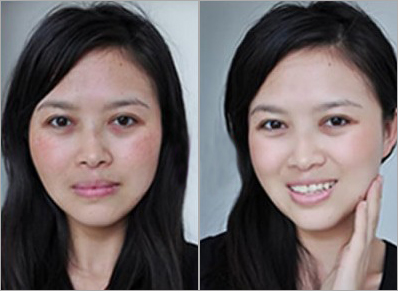 激光美容效果怎么樣