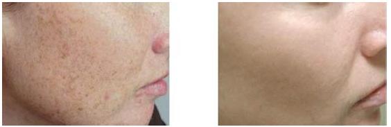 激光去色素價格是多少