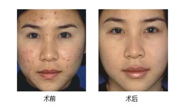 激光祛痘價格多少錢