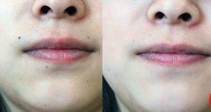 激光去痣效果怎么樣