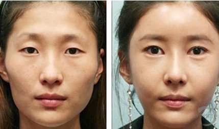 自體脂肪豐額頭手術(shù)有什么優(yōu)點(diǎn)