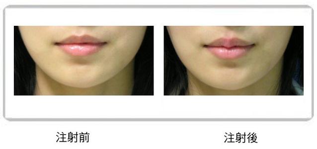 伊維蘭豐唇手術(shù)價格是多少 - 珍美網(wǎng)