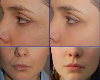 電波拉皮效果能維持多久